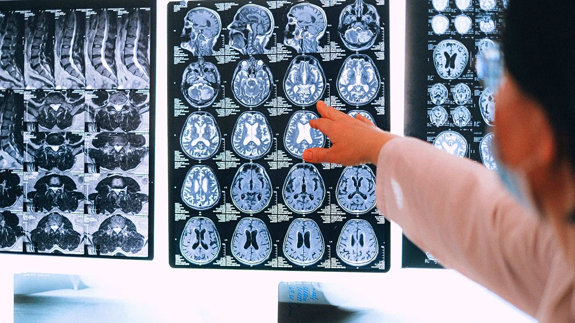 Biraz Nöropsikoloji Konuşalım: Sağ Beyin - Sol Beyin ve Duygular